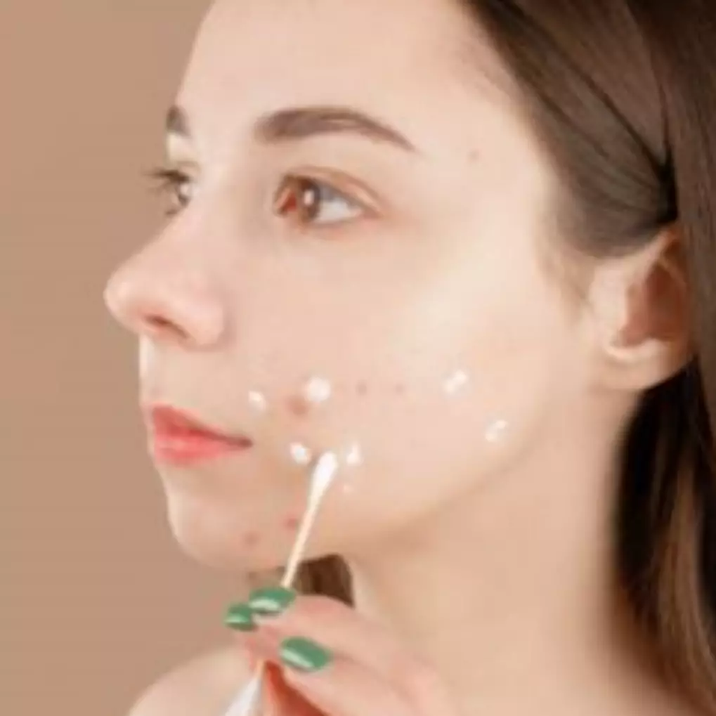 9 Skincare untuk menghilangkan bekas jerawat di bawah Rp 150 ribu