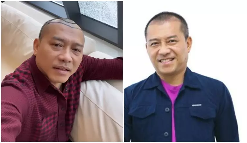 Anang Hermansyah sebelum dan sesudah transplantasi rambut © Instagram