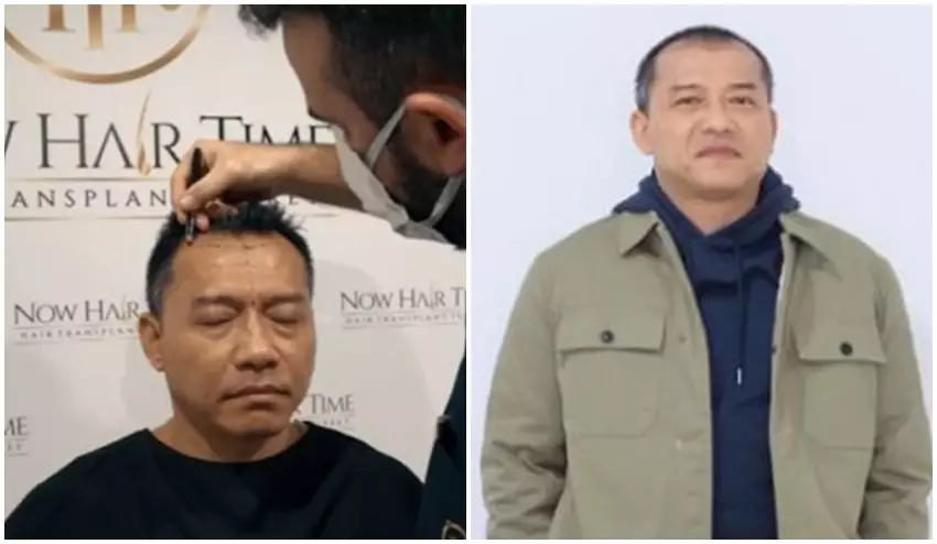 Anang Hermansyah sebelum dan sesudah transplantasi rambut © Instagram