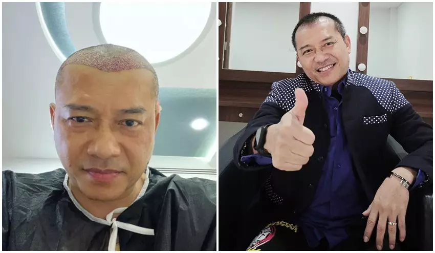 Anang Hermansyah sebelum dan sesudah transplantasi rambut © Instagram