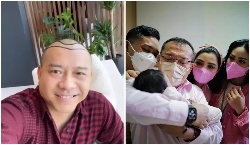 Anang Hermansyah sebelum dan sesudah transplantasi rambut © Instagram