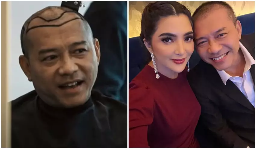 Anang Hermansyah sebelum dan sesudah transplantasi rambut © Instagram