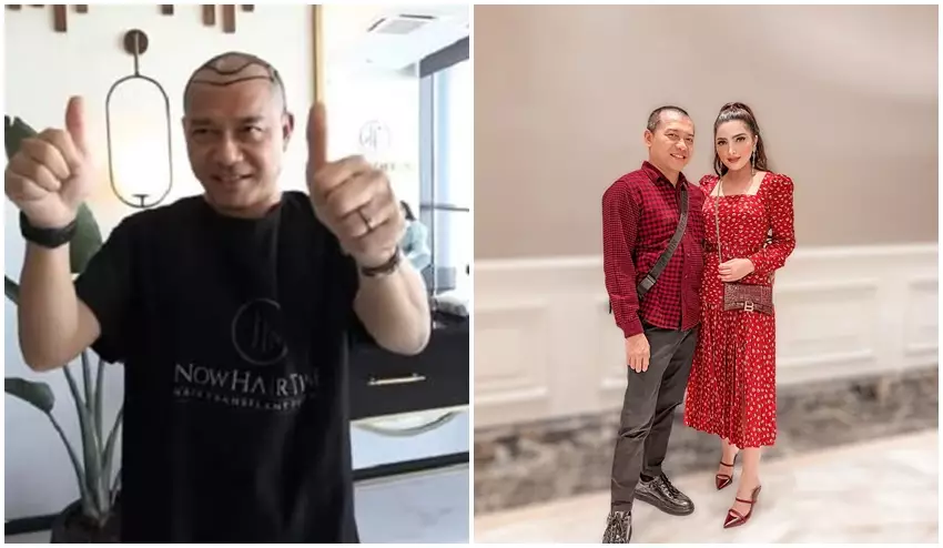 Anang Hermansyah sebelum dan sesudah transplantasi rambut © Instagram