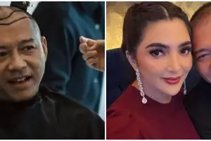 9 Potret Anang Hermansyah sebelum dan sesudah transplantasi rambut