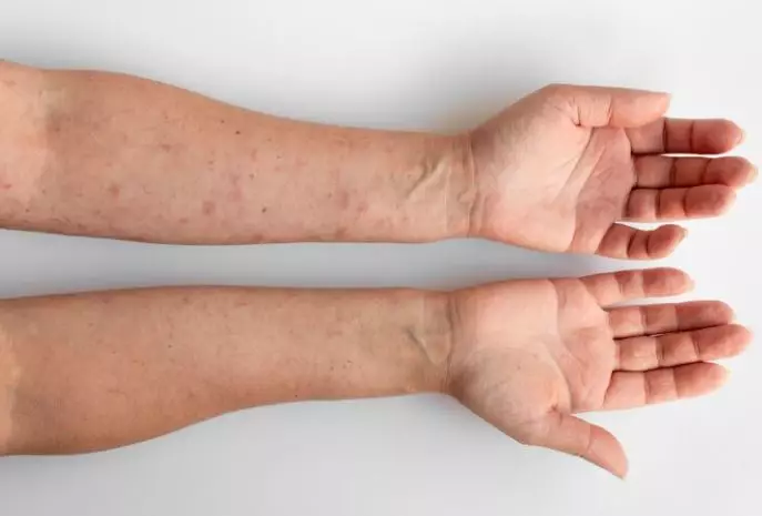 Ulkus dekubitus adalah luka pada kulit  © 2022 berbagai sumber 