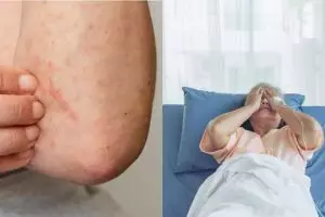 Ulkus dekubitus adalah luka pada kulit, kenali gejala dan penyebabnya