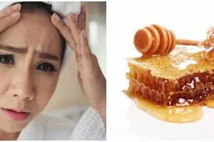 11 Cara menghilangkan biang keringat di wajah dengan bahan alami