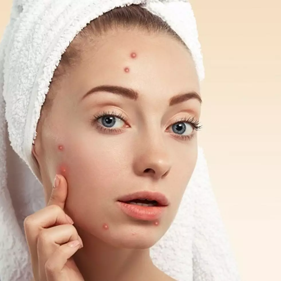 7 Skincare Viva untuk mengatasi kulit berjerawat, wajah jadi halus