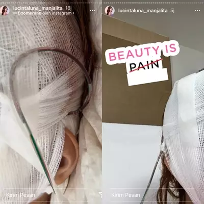 Momen Lucinta Luna operasi wajah © Instagram/@lucintaluna_manjalita