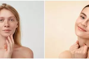 Mengenal freckles wajah, penyebab dan cara mengatasinya