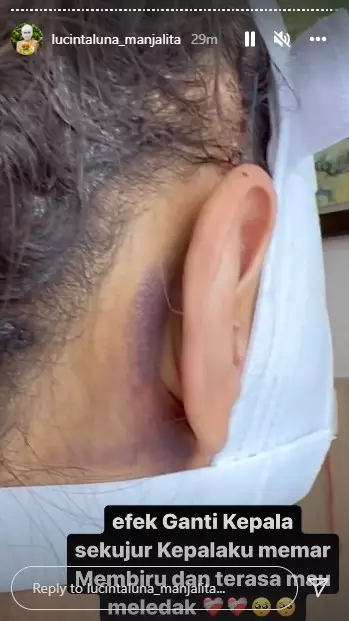 Potret kondisi Lucinta Luna usai operasi wajah © Instagram