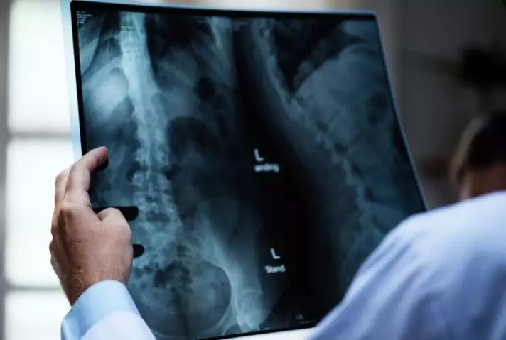 Skoliosis adalah kelainan tulang belakang © 2022 berbagai sumber Skoliosis adalah kelainan tulang belakang © 2022 berbagai sumber