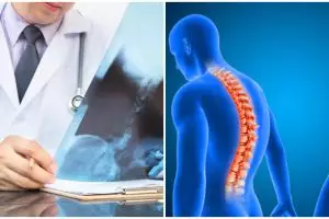 Kifosis adalah kelengkungan pada tulang, kenali gejala dan penyebabnya