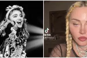 Viral potret wajah Madonna usai operasi plastik, bikin fans prihatin