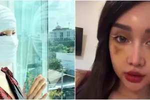 9 Potret Lucinta Luna usai operasi plastik, ganti nama jadi Luna Lisa