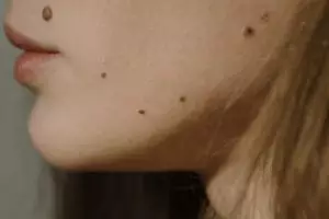 Di dahi sampai hidung, cek makna tahi lalat berdasarkan letaknya