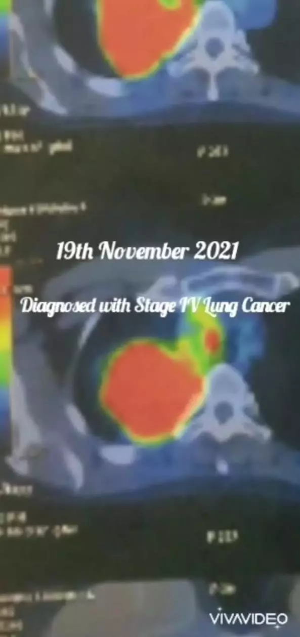 perjuangan kiki fatmala lawan kanker stadium 4 © instagram