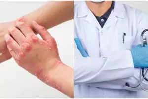 Sindrom Ramsay Hunt adalah, kenali gejala, penyebab, dan perawatan