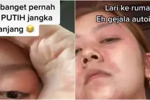Wanita ini rutin infus putih hingga berujung autoimun, kisahnya viral