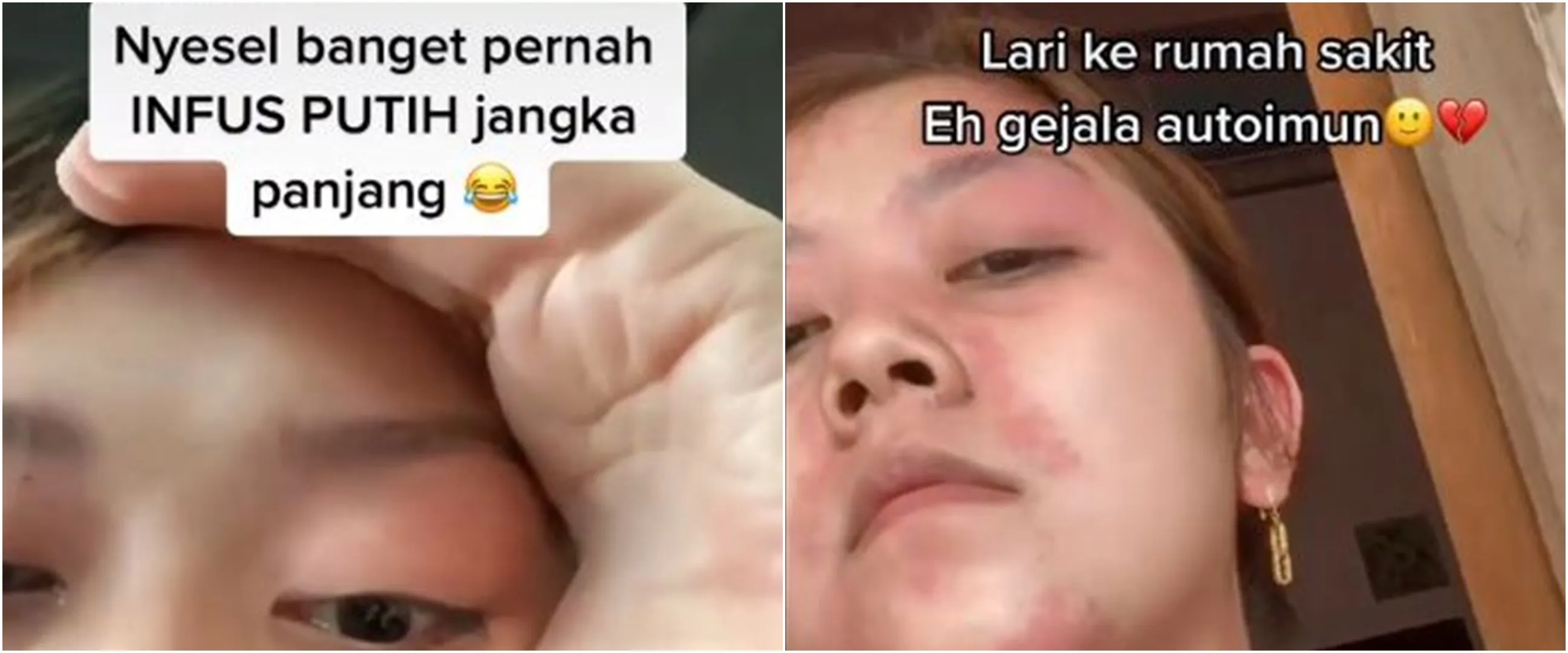 Wanita ini rutin infus putih hingga berujung autoimun, kisahnya viral