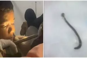 Bocah ini mengeluh sakit hidung, ternyata ada binatang di dalamnya