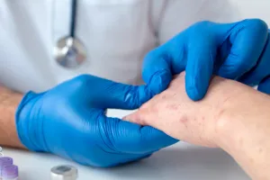 10 Bahan makanan ini bantu percepat pemulihan penyakit cacar monyet