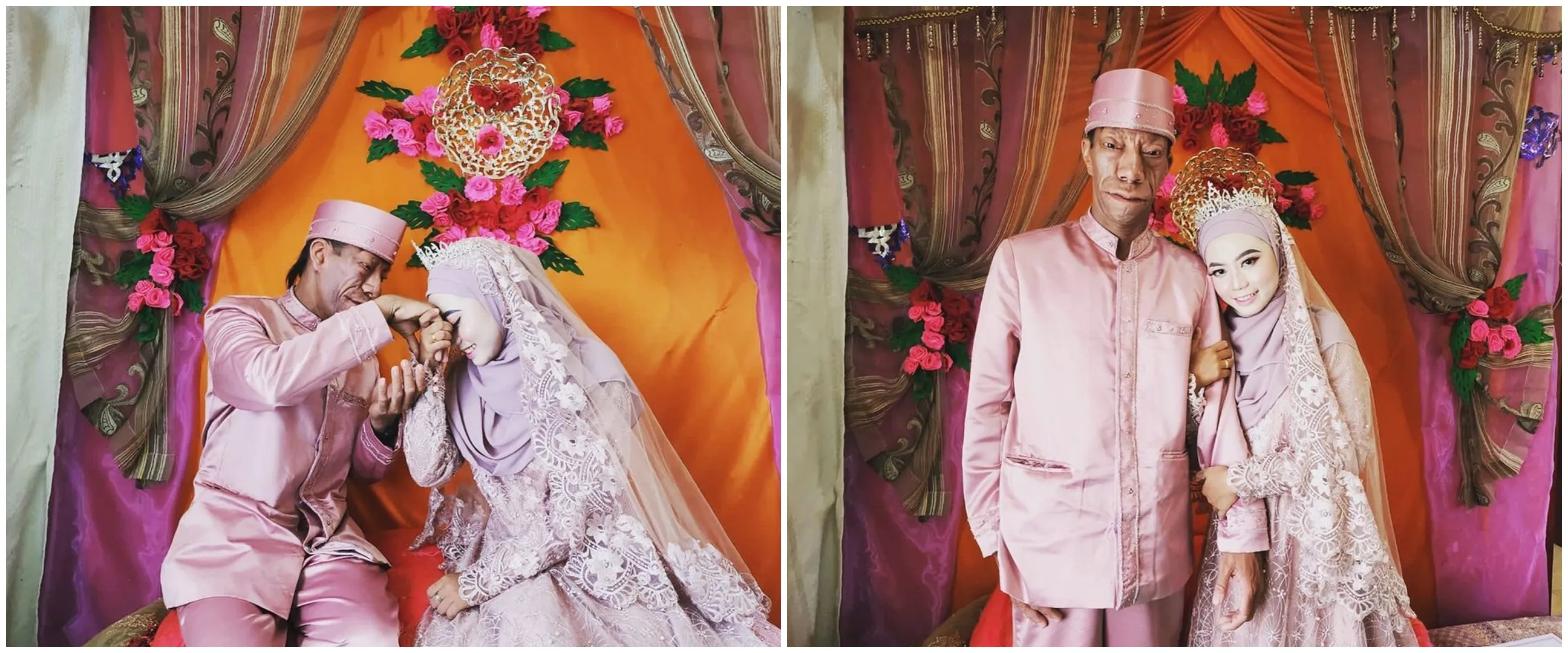 5 Momen Surya Manurung pengidap sindrom langka dan istri usai nikah