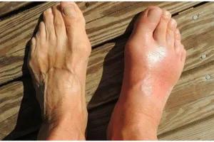 Cara membuat minuman herbal untuk bantu turunkan asam urat