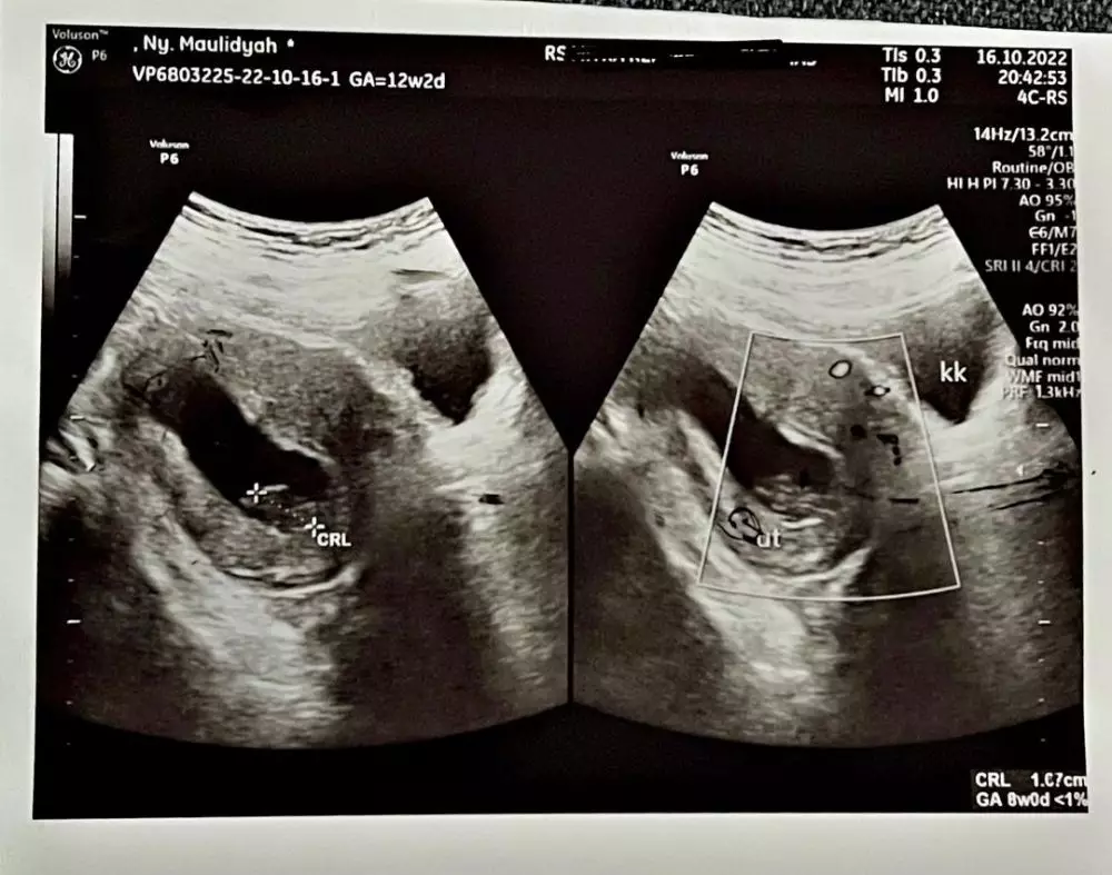 via vallen keguguran © Instagram