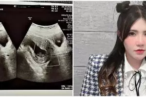 Cerita Via Vallen pertahankan janin hingga pendarahan dan pingsan