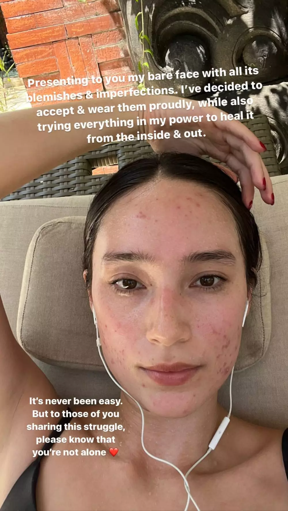 Tatjana Saphira luka jerawat © Instagram