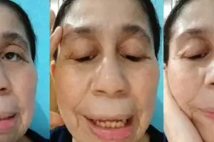Disangka editan punya wajah mirip nenek-nenek, wanita 28 tahun ini ternyata mengidap penyakit langka