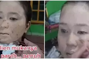 Alami jerawatan parah dan pakai krim, hasil makeup pengantin ini antilongsor dan flawless pol