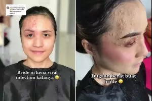 Pengantin ini wajahnya terkena infeksi dirias MUA hasilnya bikin pangling, bukti skill makeup jempolan