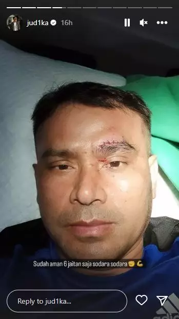 Judika tetap jadi juri usai pelipisnya dijahit © 2022 berbagai sumber