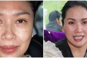 Menolak tua di usia 56 tahun, potret Titi DJ sebelum dan sesudah operasi antiaging ini bikin melongo