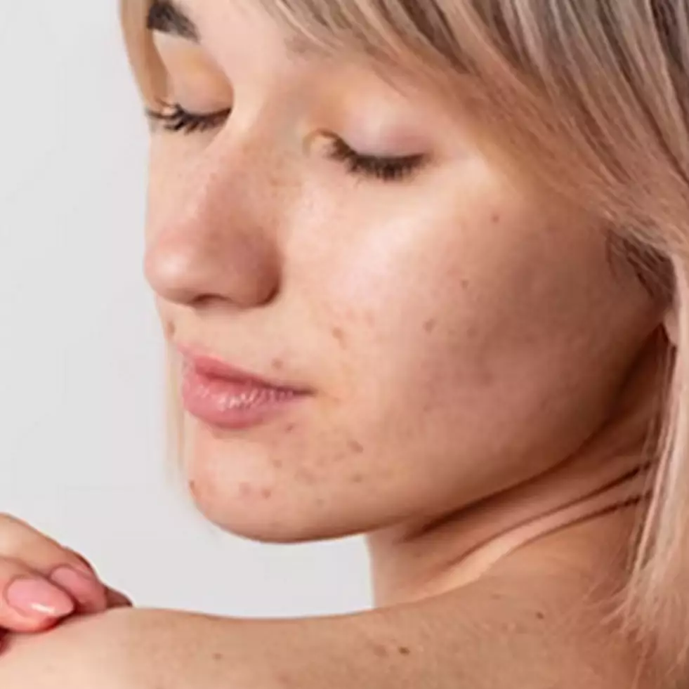 10 Cara menghilangkan jerawat punggung pakai bahan dapur, mudah dilakukan di rumah