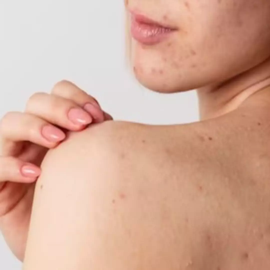 Bikin mulus dan bebas gatal, ini cara menghilangkan jerawat punggung pakai 1 jenis buah