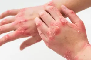 Cuma pakai 3 bahan alami, begini cara mengatasi kurap agar kulit kembali mulus dan bebas gatal