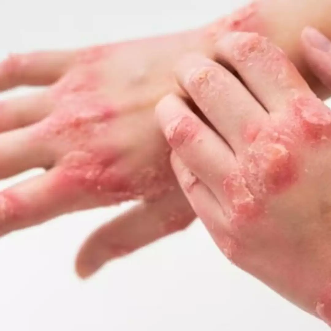 Cuma pakai 3 bahan alami, begini cara mengatasi kurap agar kulit kembali mulus dan bebas gatal