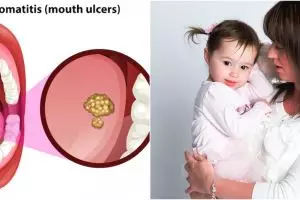 9 Penyebab sariawan pada anak, orang tua wajib tahu cara mengobati dan pencegahannya