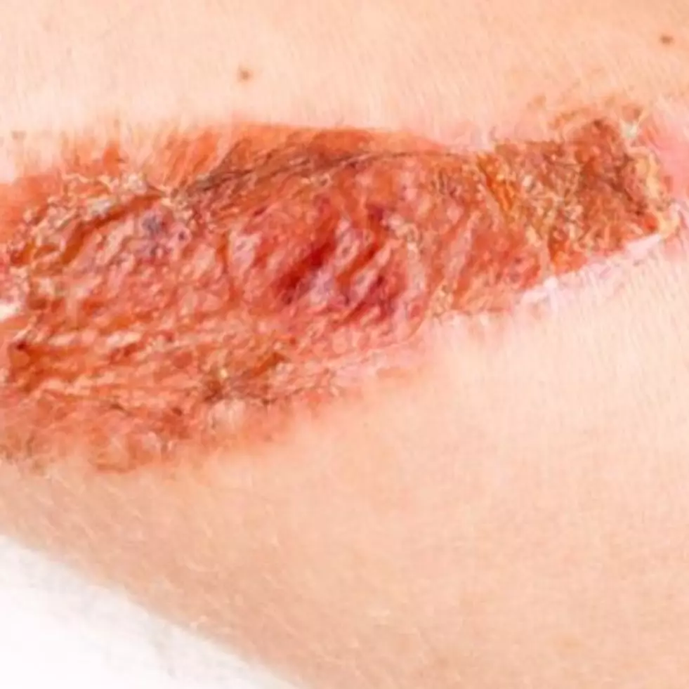 Hanya butuh 2 bahan dapur, begini cara menyamarkan bekas koreng pada kaki agar mulus kembali