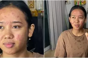 Skill MUA diuji, transformasi wanita berjerawat parah dirias jadi pengantin Bali ini bikin melongo