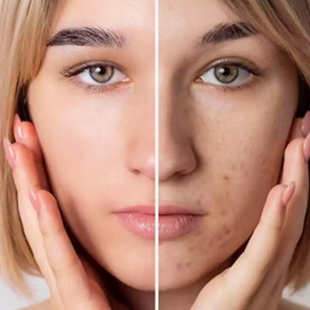 Bikin kulit kembali sehat, begini 7 cara atasi orange peel skin secara alami