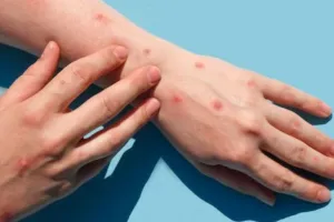 Cuma pakai 2 bahan alami, ini trik menghilangkan bekas cacar agar kulit jadi mulus