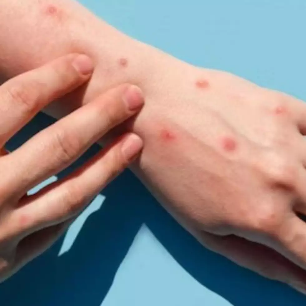 Cuma pakai 2 bahan alami, ini trik menghilangkan bekas cacar agar kulit jadi mulus