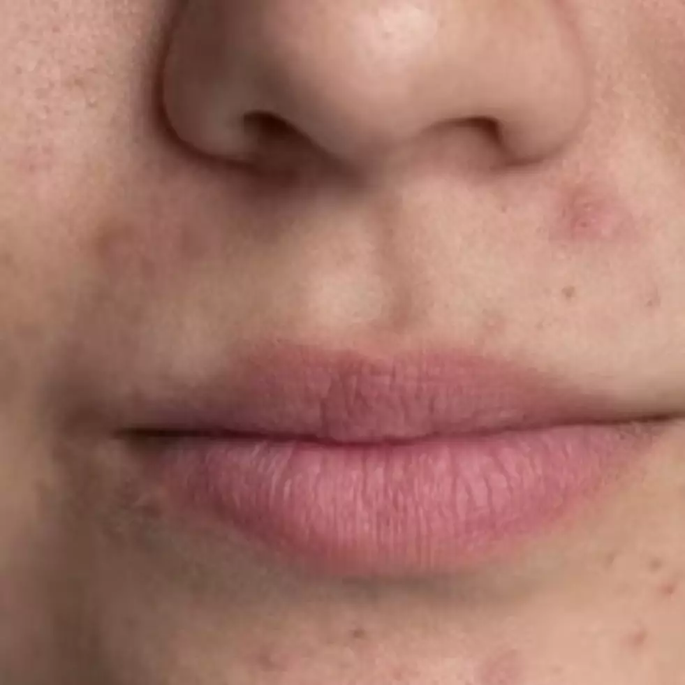 Cuma pakai 2 bahan alami, ini cara menghilangkan beruntusan pada wajah ala rumahan