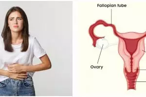 11 Penyebab kista pada wanita, kenali gejala dan cara pencegahannya