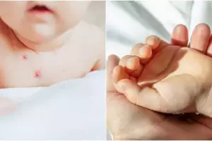 11 Penyebab herpes pada anak, kenali gejala dan ketahui cara pencegahannya
