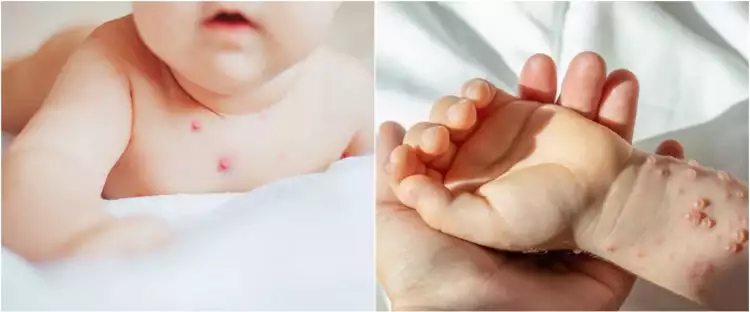 11 Penyebab herpes pada anak, kenali gejala dan ketahui cara pencegahannya